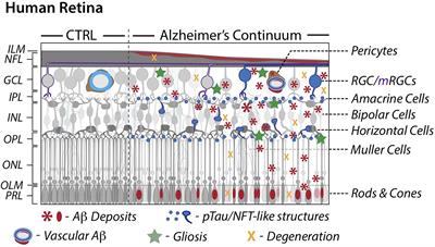 Alzheimer’s Retinopathy: Seeing Disease in the Eyes